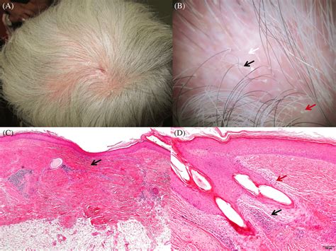 A Diffuse Alopecic Patches In Vertex And Parietal Areas B