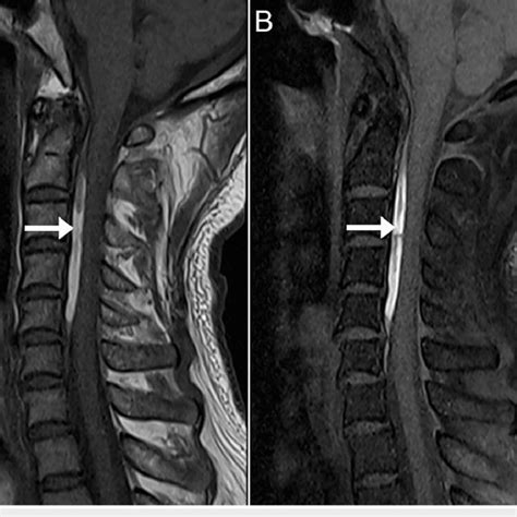 Magnetic Resonance Imaging Of The Cervical Spine Midsagittal