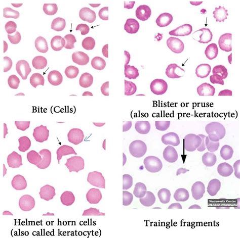 Abnormal Red Blood Cells Morphology And Possible Causes Medical