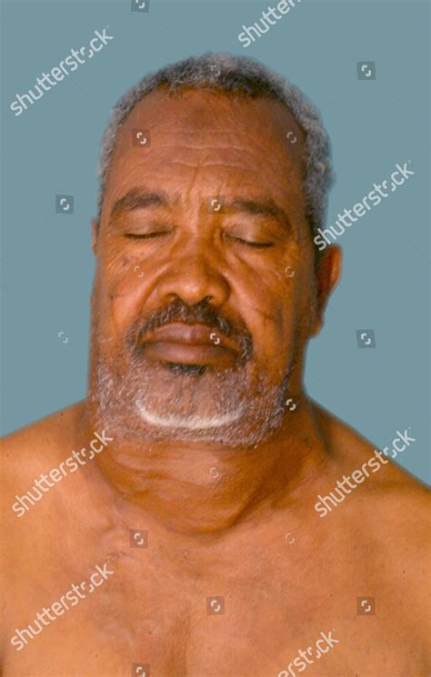 Patient Has Multinodular Goitre Swelling Neck Editorial Stock Photo