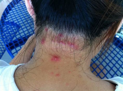 Best Over The Counter Scalp Folliculitis Treatments Care For Yoo