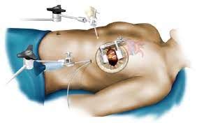 Chirurgie Coronaire Mini Invasive Chirurgie Cardiaque Prof Sotirios Marinakis