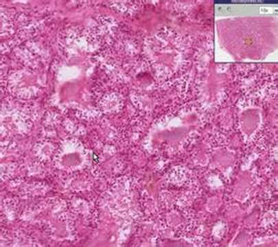 Check spelling or type a new query. Histopathology Thyroid--Graves Disease - YouTube