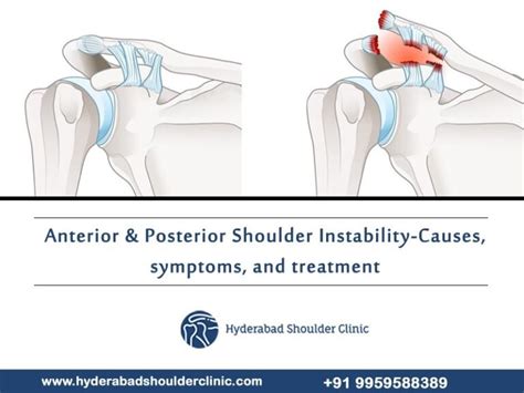 Anterior And Posterior Shoulder Instability Causes Symptoms And