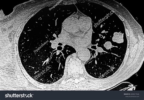 Chest Ct Scan Showing Left Lung Stock Photo 2009617646 Shutterstock