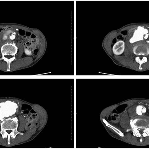 A Contrast Enhanced Computed Tomography Scan Revealed An Abdominal