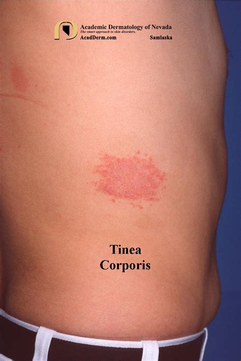 Tineacorporis1samlaska Academic Dermatology Of Nevada