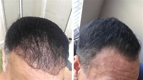 480 x 360 jpeg 25 кб. iRestore Laser Hair Growth System - PrioMed International Ltd.