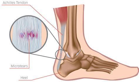 Achilles Tendonitis Specialist Downtown And Midtown New York Ny