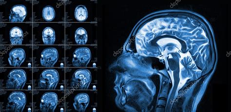 Risonanza Magnetica Imaging Del Cervello Foto Stock Foto Immagini My