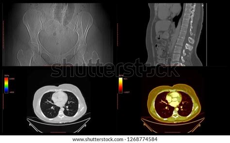 Medical Imaging Human Thorax Abdomen Pelvis Stock Photo 1268774584