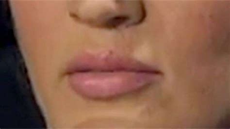Carrie Underwood Reveals Facial Scar Worries Disfigurement Would