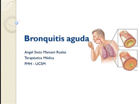 El Mundo Médico Bronquitis aguda una patología muy frecuente