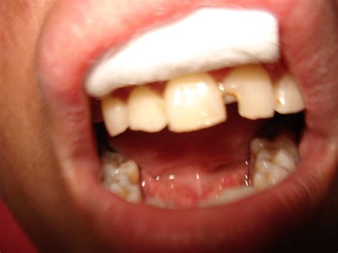 Casos Clínicos Odontologicos TÉcnica Restauradora Operatoria Dental
