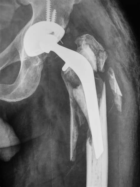 Case 1 Periprosthetic Fracture Total Hip Replacement Dr Girish
