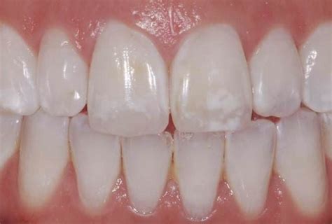 White Spots On Teeth Archives Dr Miski