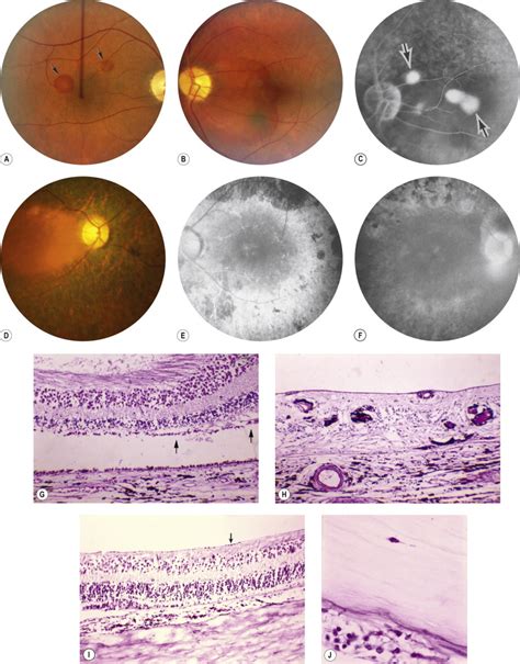 Heredodystrophic Disorders Affecting The Pigment Epithelium And Retina