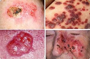 3 types of skin cancer - Cancer Blog Skin Cancer  