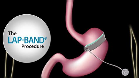 Fast Facts About The Lap Band® Procedure Youtube