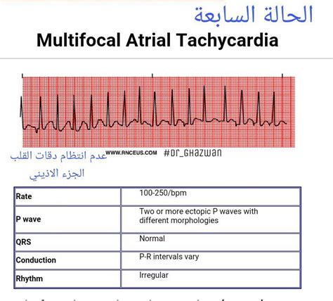 شرح تخطيط القلب الكهربائي Ecg وتحديد الحالة من رسم القلب