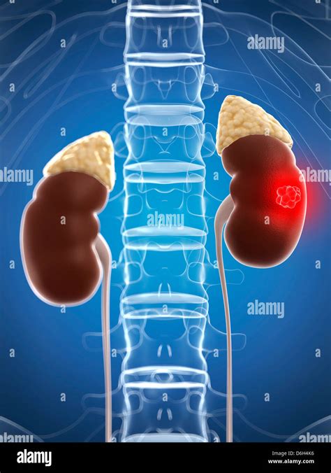Kidney Cancer Artwork Stock Photo Alamy