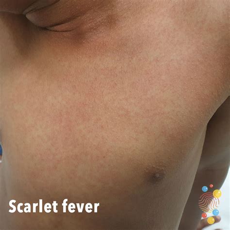 Strep A And Scarlet Fever Healthier Together