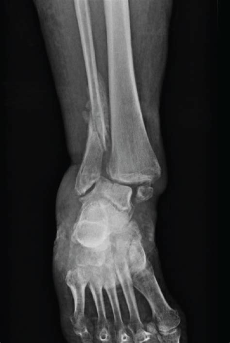 Progression Toward Chronic Ankle Deformity And Malunion Download