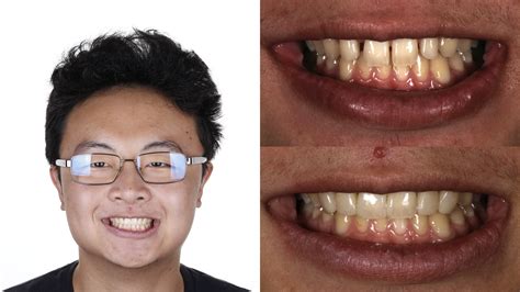 before and after composite veneers whitening 2