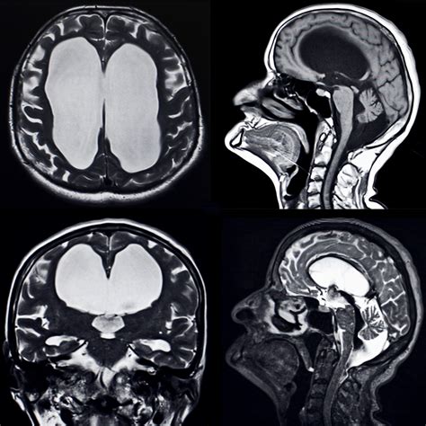 Normal Pressure Hydrocephalus Neurosurgery Of St Louis Stl Brain Spine Doctors