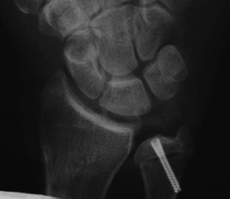 Ulnar Sided Wrist Pain In The Athlete Clinics In Sports Medicine