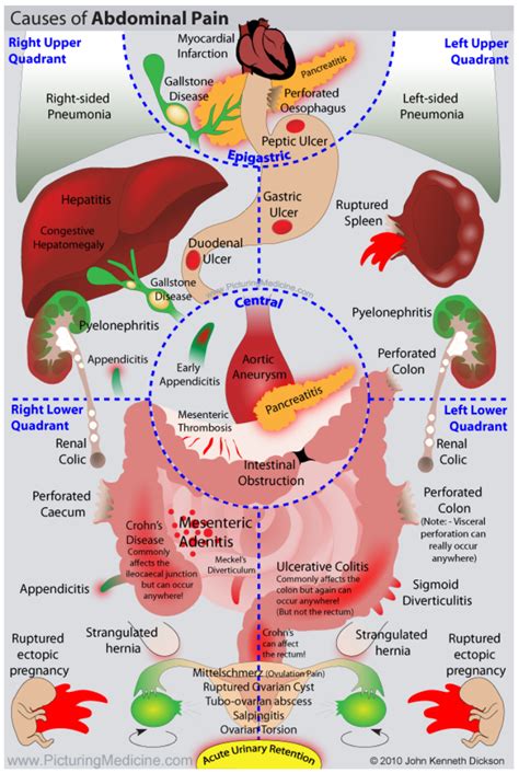 Diagram Of Right Abdominal Pain