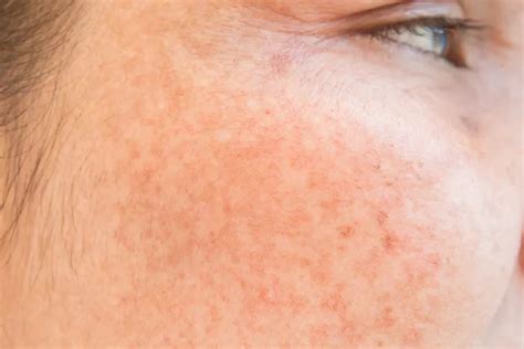 Qanda What Causes Dark Spots On Skin And What Works To Fade Them