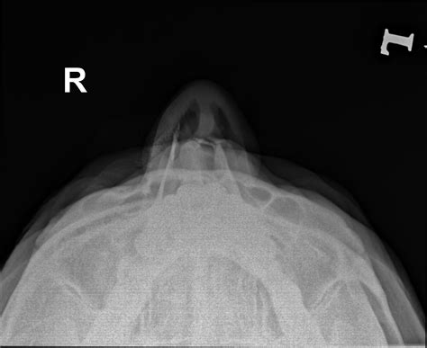 Nasal Bone Fracture Image