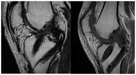 Mri Of A Knee 5 Years After A Simultaneous Arthroscopic Reconstruction