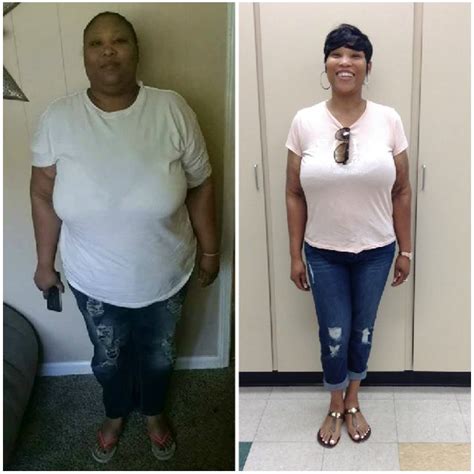 Low Bmi Gastric Sleeve Before And After