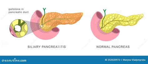 Acute Pancreas Inflamation Caused By The Obstruction Of The Pancreatic