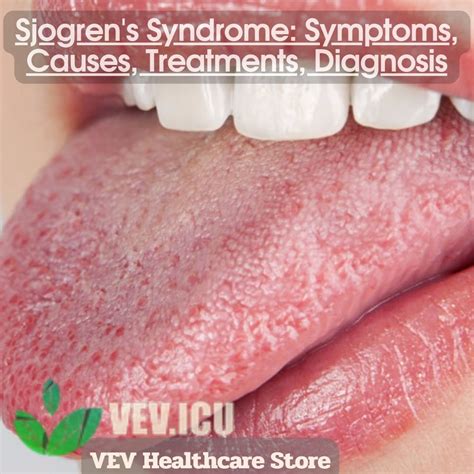 Sjogrens Syndrome Symptoms Causes Treatments Diagnosis