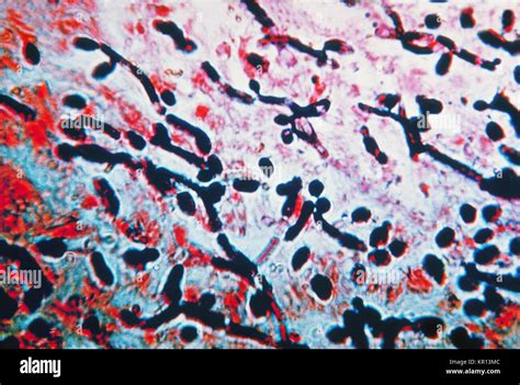 Candidiasis Opportunistic Infectious Condition Caused Hi Res Stock