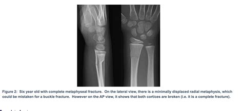 Buckle And Greenstick Fractures Of The Distal Radius Sports Medicine