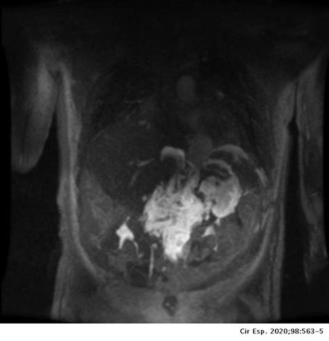 Bilateral Chylothorax And Chylous Ascites Resulting From The