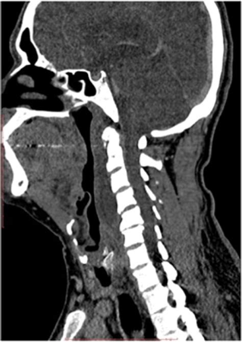 Contrast Enhanced Computed Tomography Cect Neck Showing Fluid
