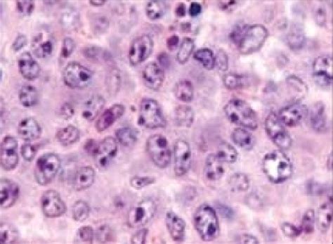 Diffuse Large B Cell Non Hodgkin Lymphoma Large Cells With Abundant