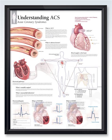 Acute Coronary Syndrome Exam Room Anatomy Poster Clinicalposters