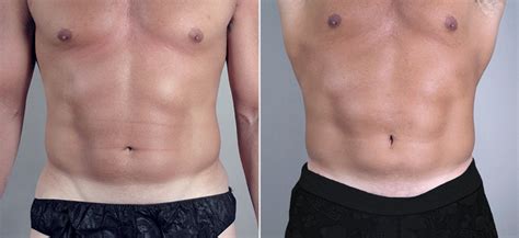 Liposuction Men My Website