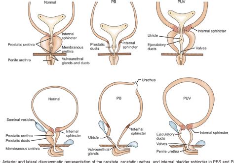 Figure 8 From Prune Belly Syndrome Versus Posterior Urethral Valve Semantic Scholar