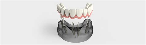Do You Know Dental Implants Can Enhance Your Oral Appearance Dental