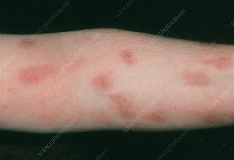 Psoriasis On The Arm Treated By Dithranol Stock Image M2400191