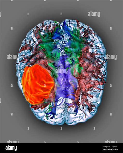 Glioblastoma Brain Cancer Coloured 3d Diffusion Tensor Imaging Dti