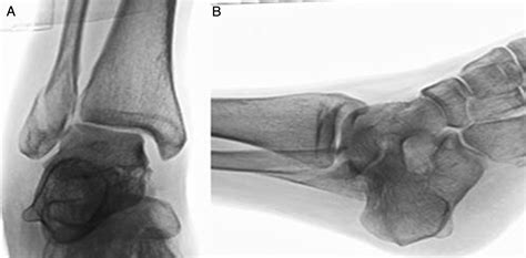 Two View Gravity Stress Imaging Protocol For Nondisplaced Type Ii
