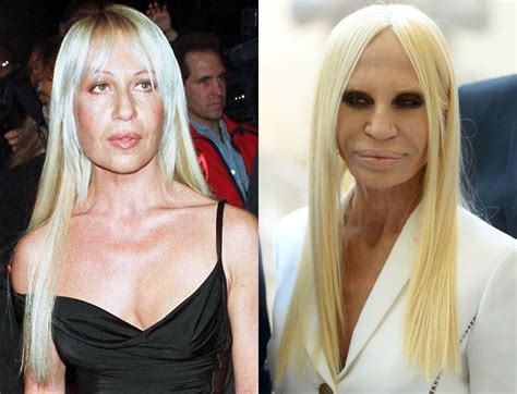 Donatella Versace Before And After Plastic Surgery Celebrity Celebrity Plastic
